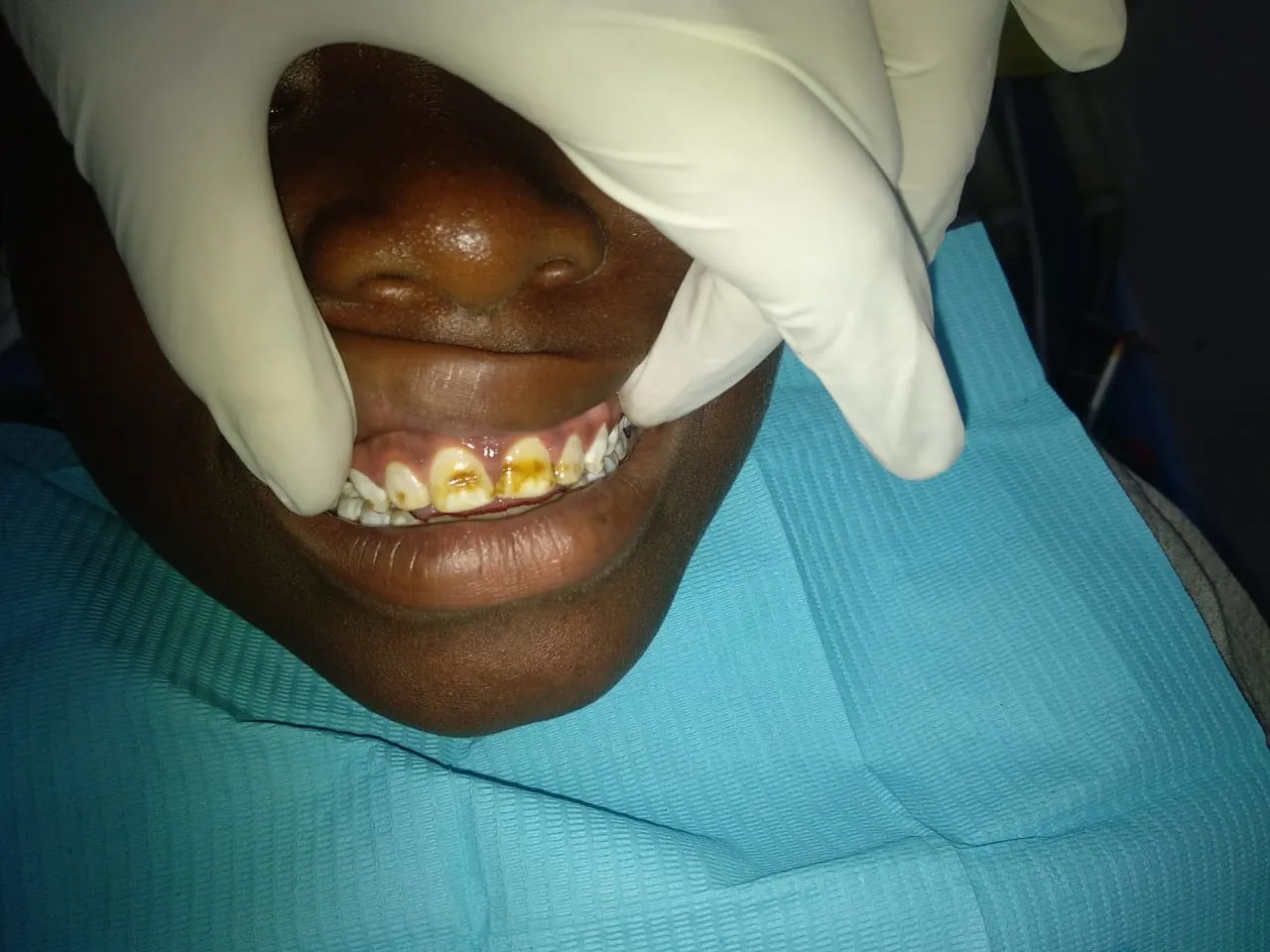 33731 bleaching agents