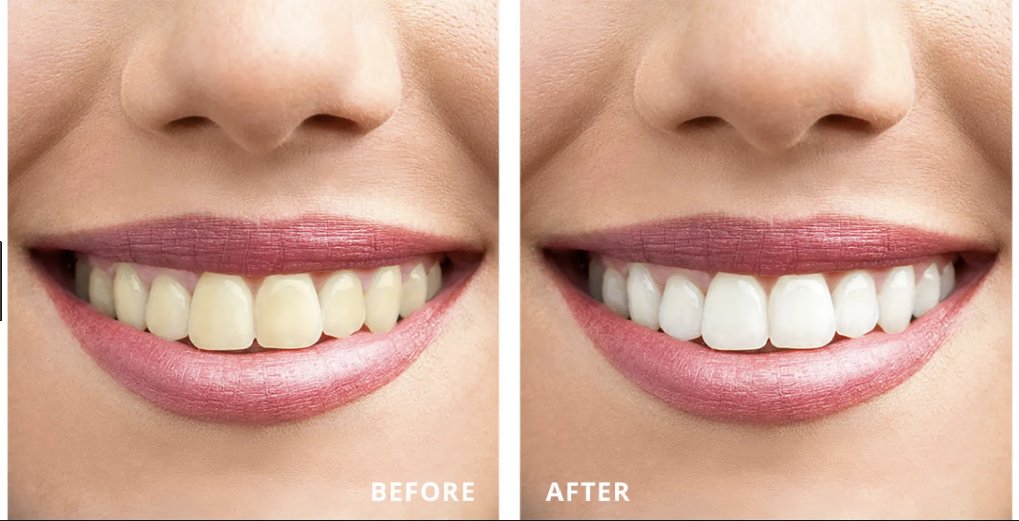 33743 teeth whitening procedure