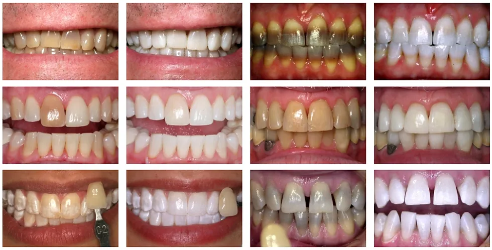 33744 in office teeth whitening