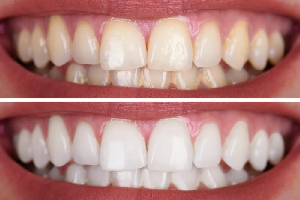 33747 in office whitening